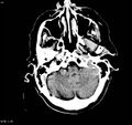 Arteriovenous malformation - cerebral (Radiopaedia 8172-9020 Axial non-contrast 3).jpg