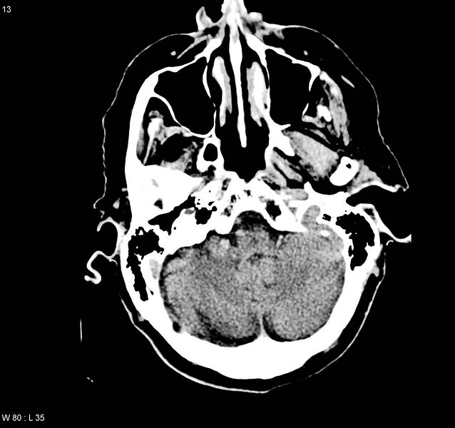 File:Arteriovenous malformation - cerebral (Radiopaedia 8172-9020 Axial non-contrast 3).jpg