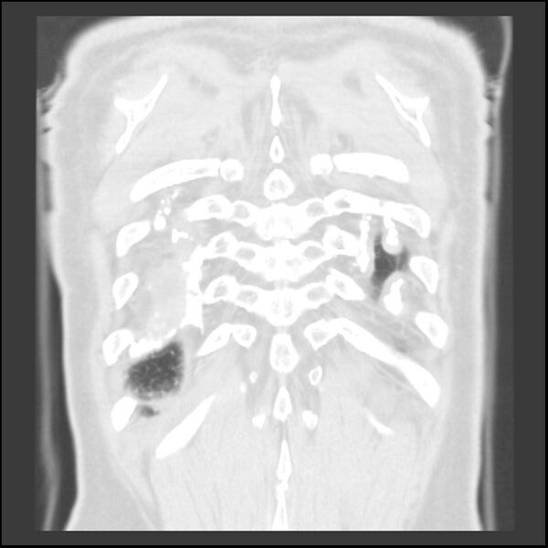 File:Asbestos-related pleural plaques (Radiopaedia 39069-41255 Coronal lung window 7).jpg