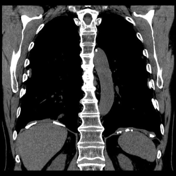 File:Asbestos-related pleural plaques (Radiopaedia 39069-41255 Coronal non-contrast 26).jpg
