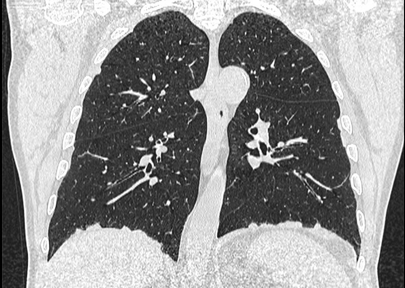 File:Asbestos pleural placques (Radiopaedia 57905-64872 Coronal lung window 179).jpg