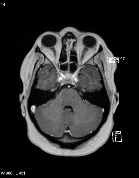 File:Astroblastoma (Radiopaedia 39792-42217 Axial T1 C+ 13).jpg