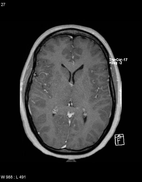 File:Astroblastoma (Radiopaedia 39792-42217 Axial T1 C+ 26).jpg