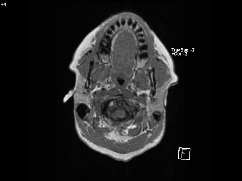 Atypical meningioma - intraosseous (Radiopaedia 64915-74572 Axial T1 44).jpg