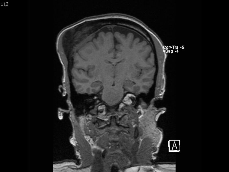 File:Atypical meningioma - intraosseous (Radiopaedia 64915-74572 Coronal T1 112).jpg