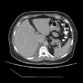 Atypical retroperitoneal lymphocoeles with large leiomyoma of uterus (Radiopaedia 32084-33024 A 12).jpg