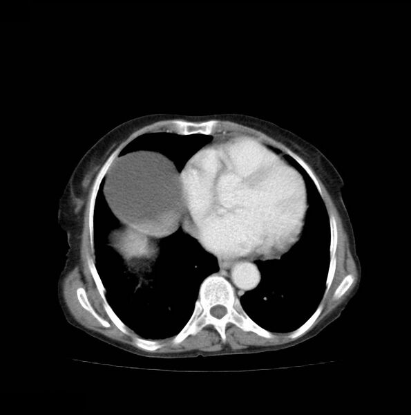 File:Autosomal dominant polycystic kidney disease (Radiopaedia 16777-16490 A 4).jpg