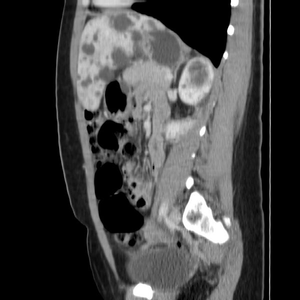 File:Autosomal dominant polycystic kidney disease (Radiopaedia 23061-23093 F 35).jpg