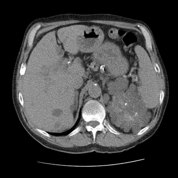 File:Autosomal dominant polycystic kidney disease (Radiopaedia 27851-28094 Axial non-contrast 56).jpg