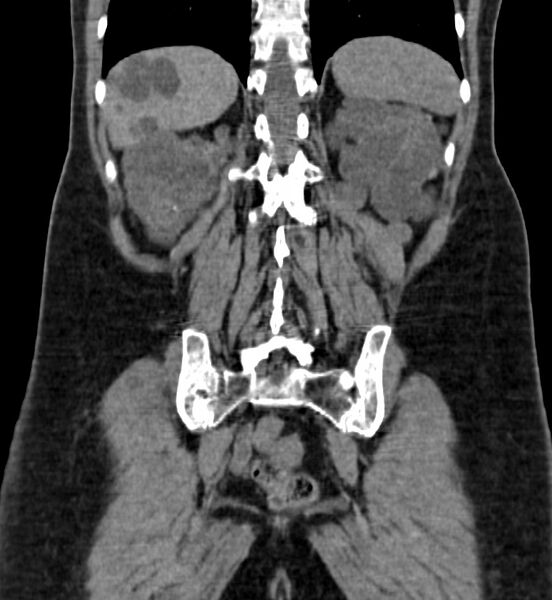 File:Autosomal dominant polycystic kidney disease (Radiopaedia 41918-44922 Coronal non-contrast 41).jpg