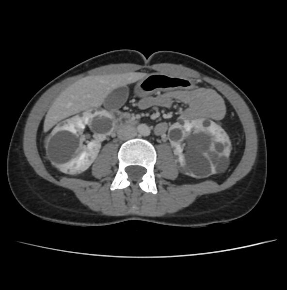File:Autosomal dominant polycystic kidney disease - early onset (Radiopaedia 40734-43387 A 43).jpg