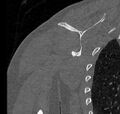 Avulsion fracture - greater tuberosity of humerus (Radiopaedia 71216-81514 Coronal bone window 55).jpg