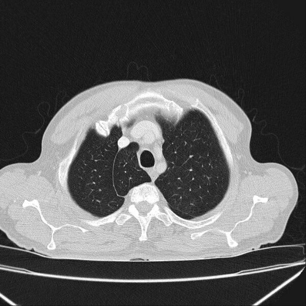 File:Azygos lobe (Radiopaedia 38259-40275 Axial lung window 13).jpg