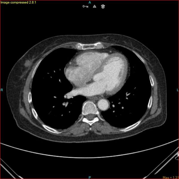 File:Azygos vein aneurysm (Radiopaedia 77824-90130 B 37).jpg