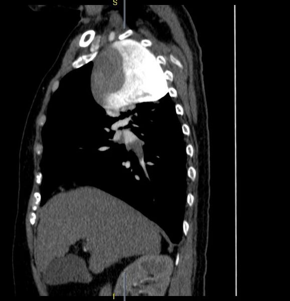 File:Azygos vein aneurysm (Radiopaedia 77824-90130 D 24).JPG