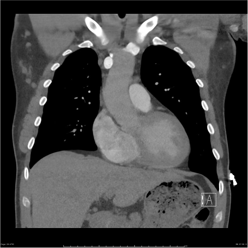 Azygos venous system anatomy (CT pulmonary angiography) (Radiopaedia 25928-26077 Coronal C+ CTPA 26).jpg