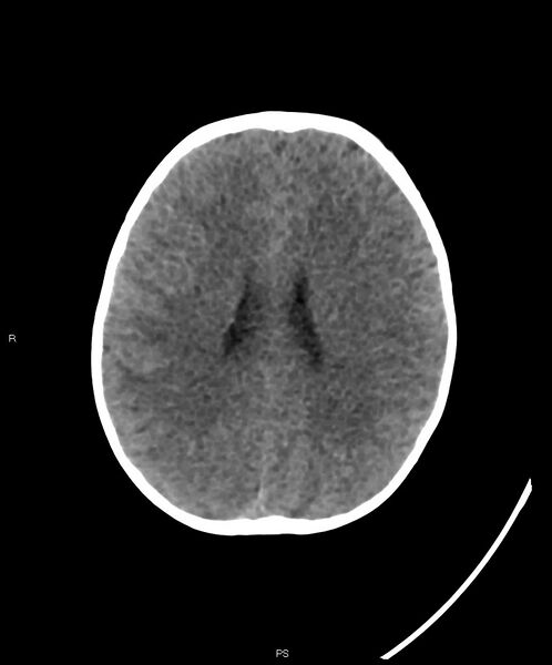File:Basal ganglia and parenchymal ischemia (Radiopaedia 45818-50083 Axial non-contrast 16).jpg