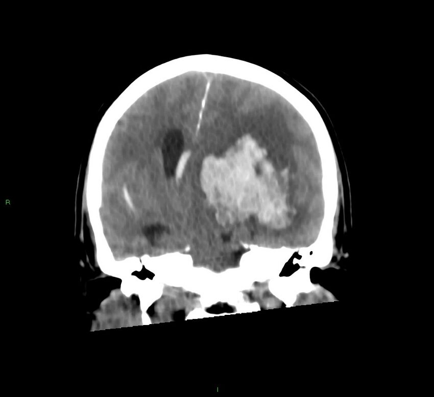 Basal ganglia hemorrhage (Radiopaedia 58775-66008 Coronal non-contrast 35).jpg
