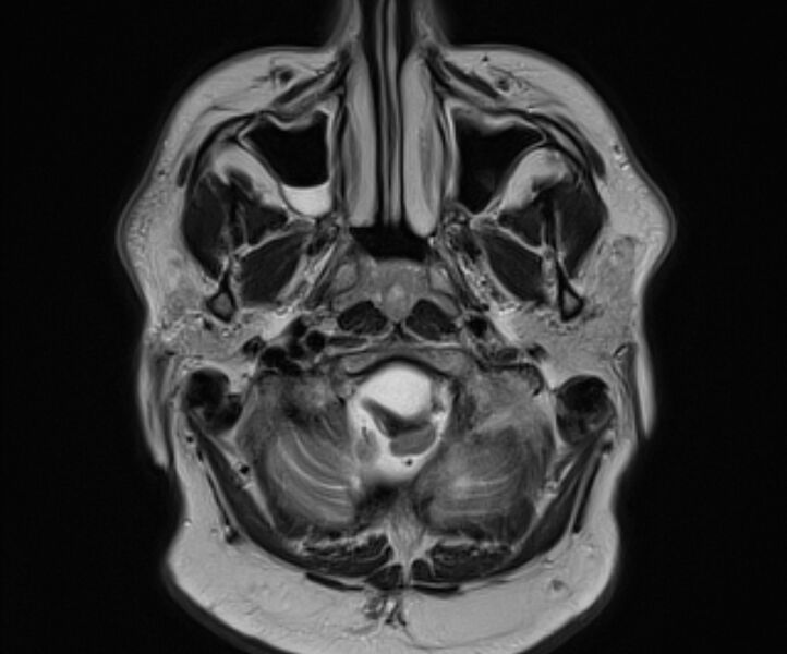 File:Basilar artery dissection (Radiopaedia 77032-88976 Axial T2 3).jpg