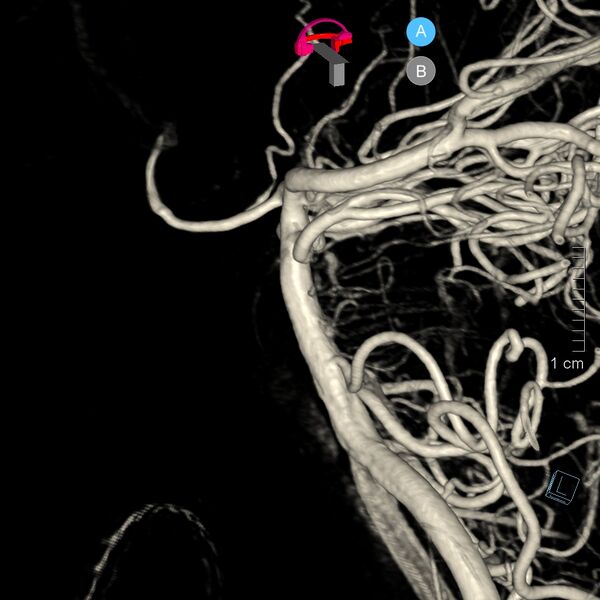 File:Basilar artery perforator aneurysm (Radiopaedia 82455-97734 3D view left VA 22).jpg