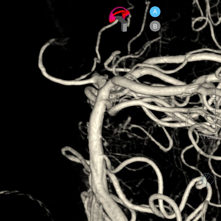 Basilar artery perforator aneurysm (Radiopaedia 82455-97734 3D view left VA 99).jpg