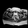 Benign seromucinous cystadenoma of the ovary (Radiopaedia 71065-81300 B 3).jpg