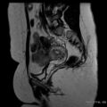 Bicornuate uterus- on MRI (Radiopaedia 49206-54297 Sagittal T2 9).jpg