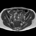 Bicornuate uterus (Radiopaedia 61974-70046 Axial T1 25).jpg