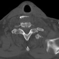 Bilateral C6-7 locked facet dislocation (Radiopaedia 28506-28748 Axial bone window 30).jpeg