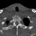 Bilateral C6-7 locked facet dislocation (Radiopaedia 28506-28748 Axial bone window 40).jpeg