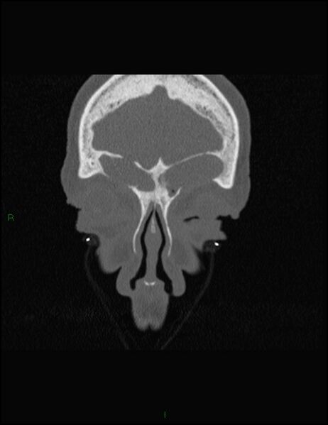File:Bilateral frontal mucoceles (Radiopaedia 82352-96454 Coronal 65).jpg