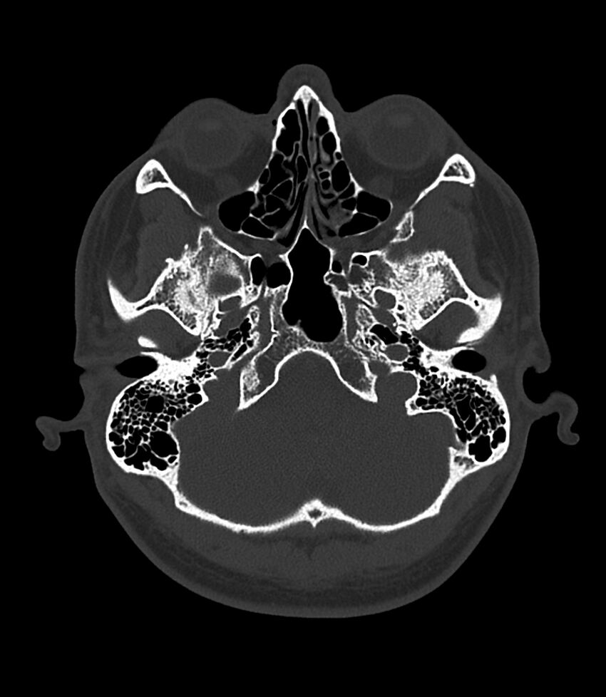 Bilateral medial canal fibrosis (Radiopaedia 85598-101344 Axial bone window 12).jpg
