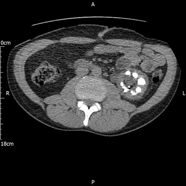 File:Bilateral medullary nephrocalcinosis with ureteric calculi (Radiopaedia 71269-81569 Axial non-contrast 58).jpg