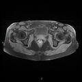 Bilateral ovarian fibroma (Radiopaedia 44568-48293 Axial T1 fat sat 23).jpg