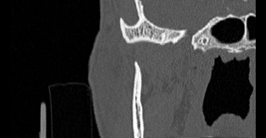 Bilateral temporal bone fractures (Radiopaedia 29482-29970 Coronal non-contrast 11).jpg