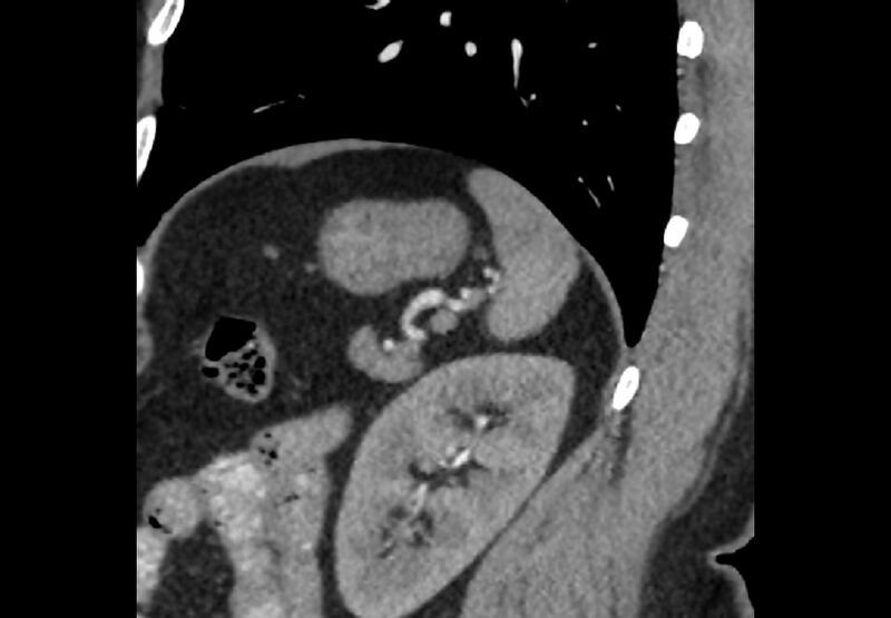 File:Bilateral urolithiasis with incidentally detected splenic artery aneurysm and left inferior vena cava (Radiopaedia 44467-48127 Ob. Sag. C+ Art. 1).jpg