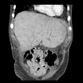 Biliary necrosis - liver transplant (Radiopaedia 21876-21846 C 7).jpg