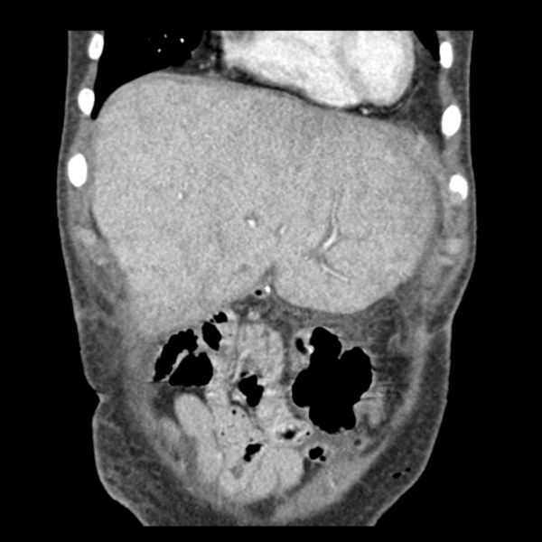 File:Biliary necrosis - liver transplant (Radiopaedia 21876-21846 C 7).jpg