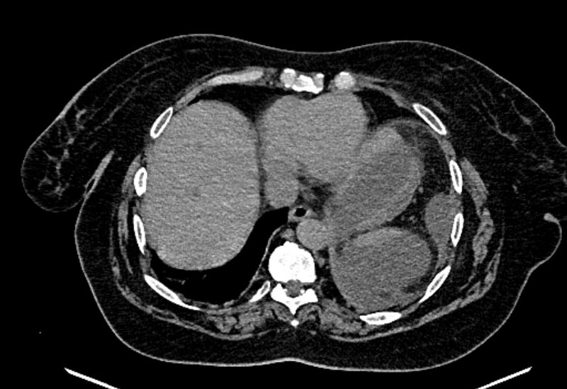 File:Biliary pancreatitis (Radiopaedia 72289-82823 Axial non-contrast 34).jpg