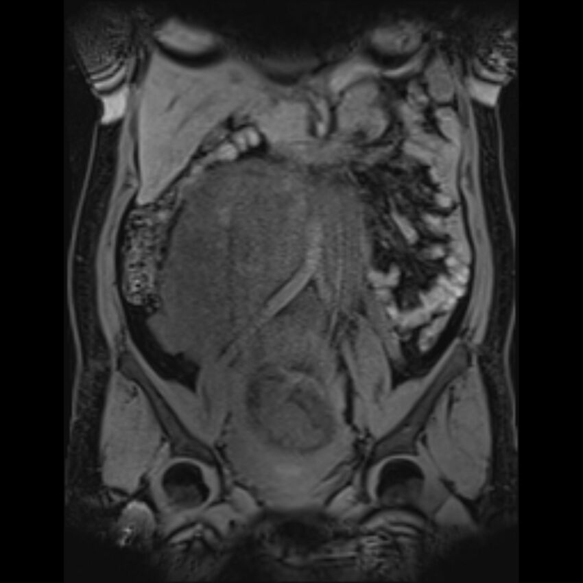 Bilobed placenta accreta (Radiopaedia 69648-79591 Coronal T1 vibe 91).jpg
