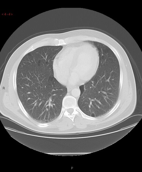File:Birt-Hogg-Dubé syndrome (Radiopaedia 53814-60013 Axial lung window 4).jpg