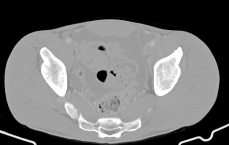 File:Blunt injury to the small bowel (Radiopaedia 74953-85987 Axial Wide 84).jpg