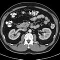 Bosniak cyst - type IV (Radiopaedia 23525-23627 renal cortical phase 24).jpg