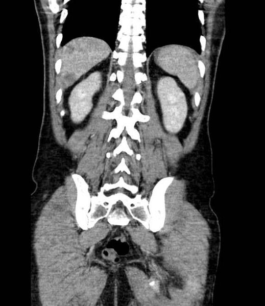 File:Bowel obstruction from colon carcinoma (Radiopaedia 22995-23028 C 60).jpg
