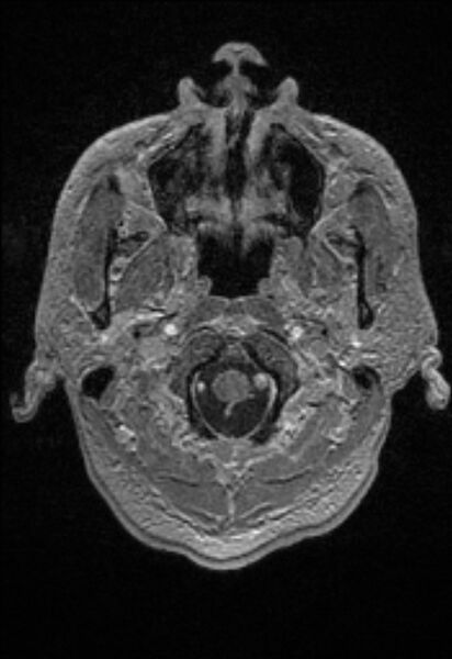 File:Brain abscess with ventriculitis (Radiopaedia 85703-101495 Axial T1 C+ 18).jpg