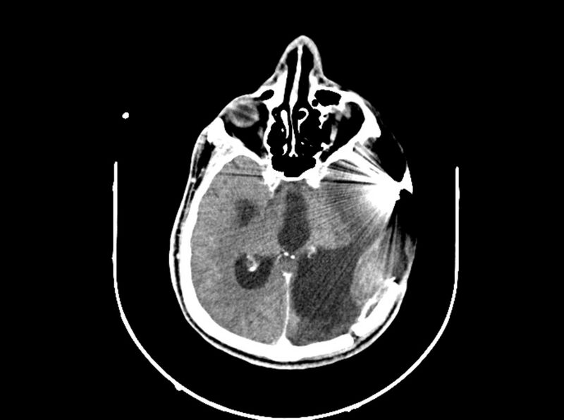 File:Brain injury by firearm projectile (Radiopaedia 82068-96088 B 119).jpg