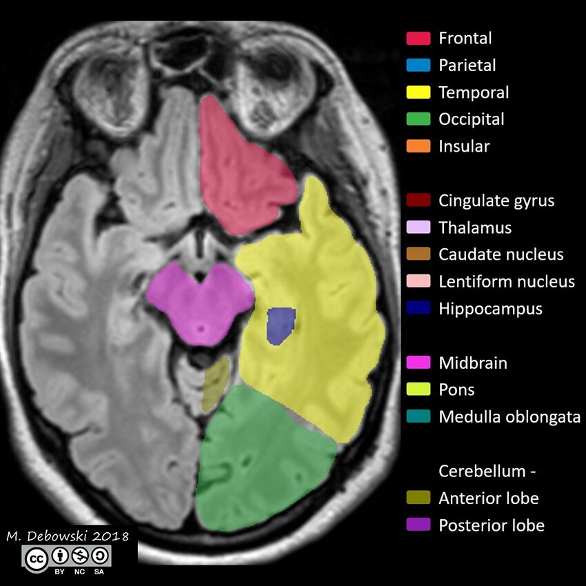 Brain lobes - annotated MRI (Radiopaedia 61691-69700 Axial 46).JPG