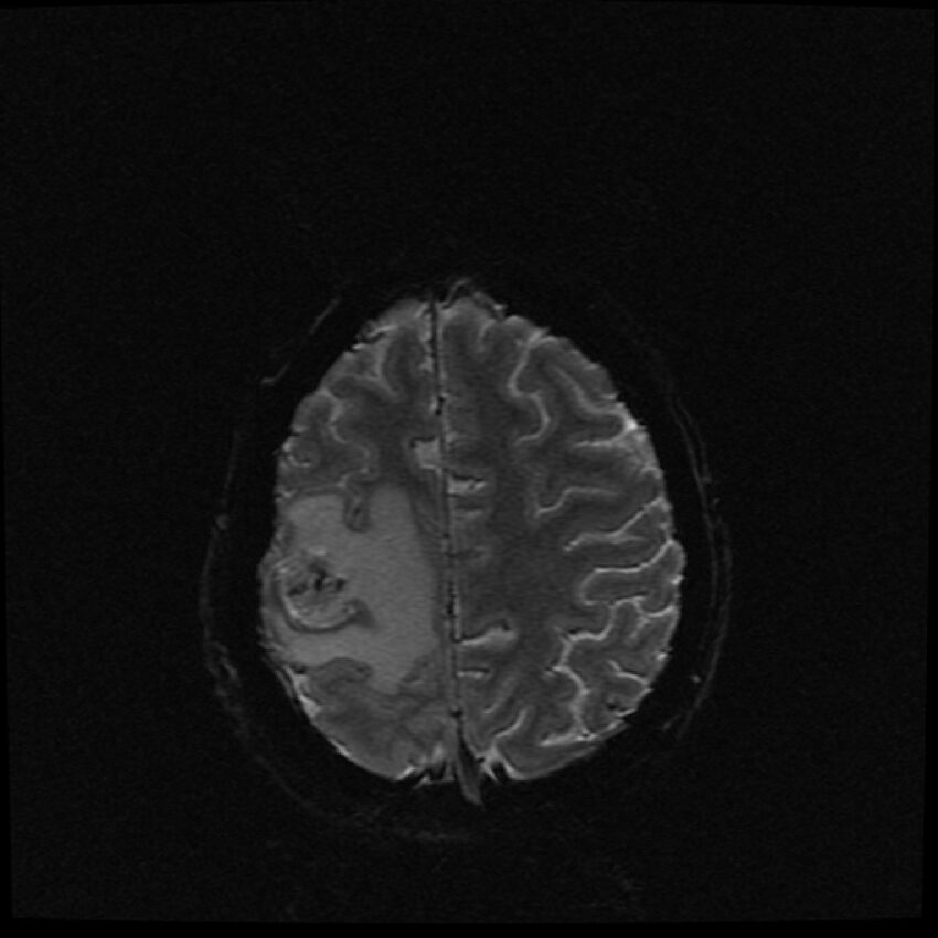 Brain metastases (renal cell carcinoma) (Radiopaedia 42571-45704 Axial SWI 8).jpg