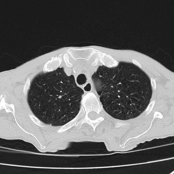File:Brain metastases from lung cancer (Radiopaedia 27849-28093 Axial lung window 13).jpg