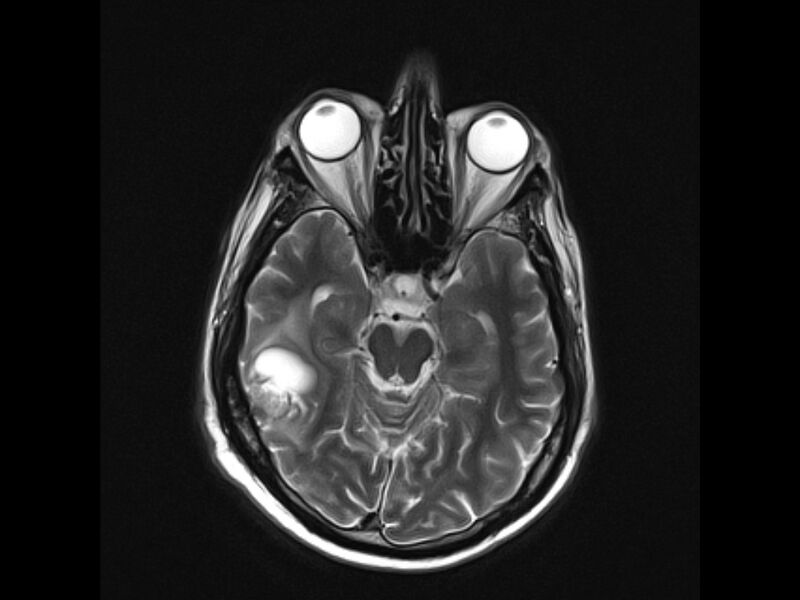 File:Brain metastases from renal cell carcinoma (Radiopaedia 42222-45297 Axial T2 10).jpg